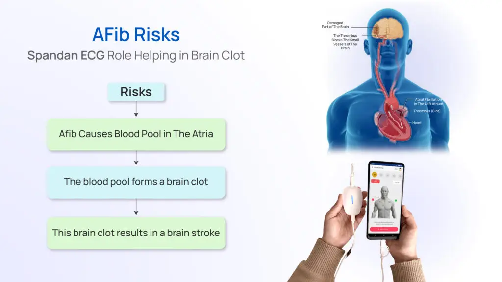 AFib Risks: Spandan ECG Role in Helping with Brain Clot