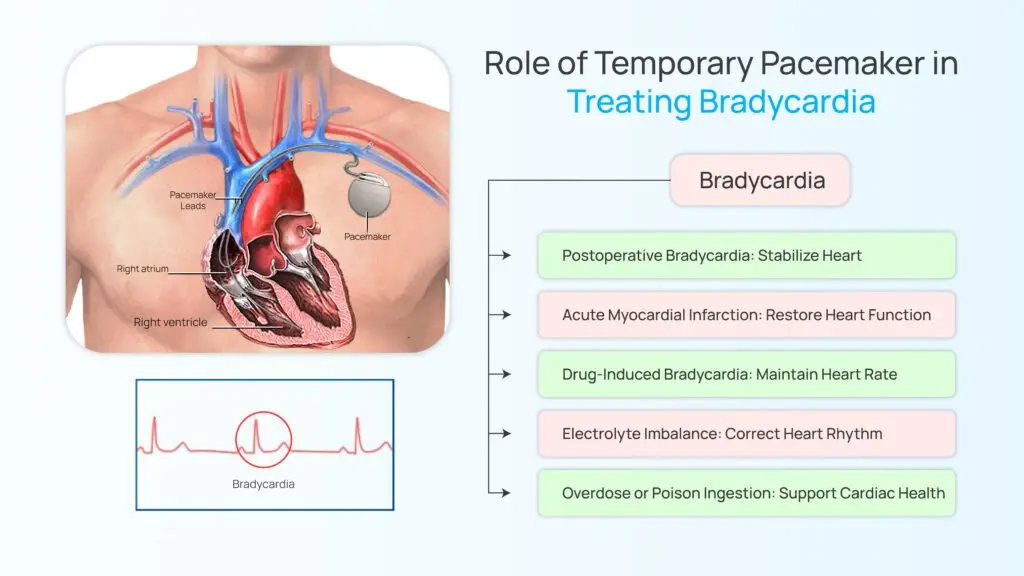 Role of Temporary Pacemaker in Treating Bradycardia