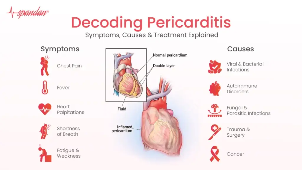 Decoding Pericarditis: Symptoms, Causes, and Treatment Explained