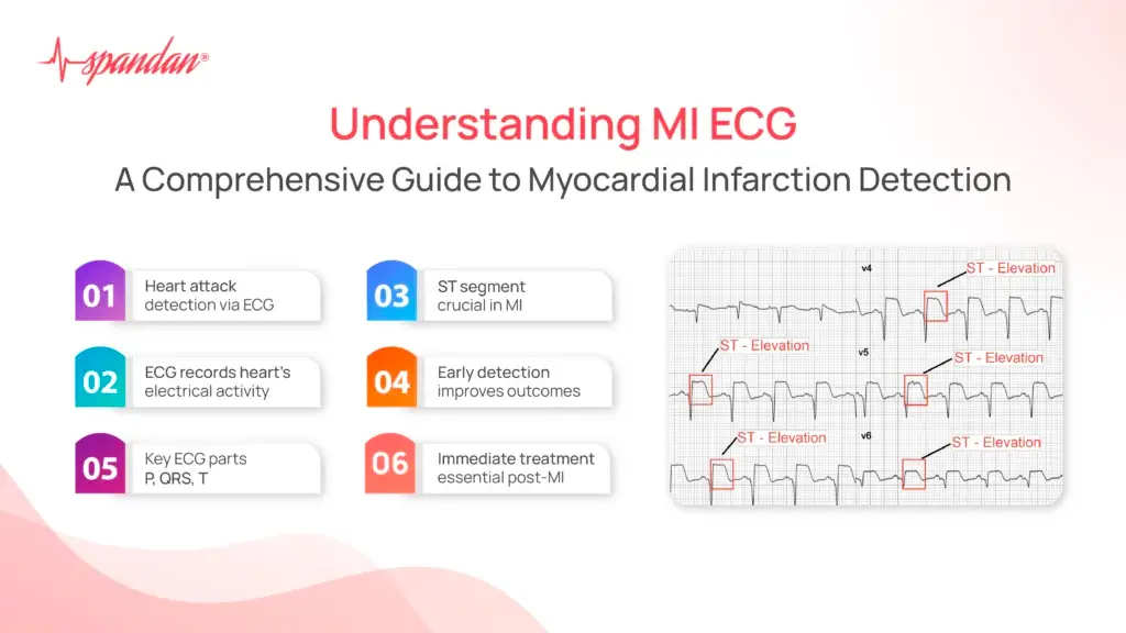 Understanding MI ECG: A Comprehensive Guide to Myocardial Infarction Detection