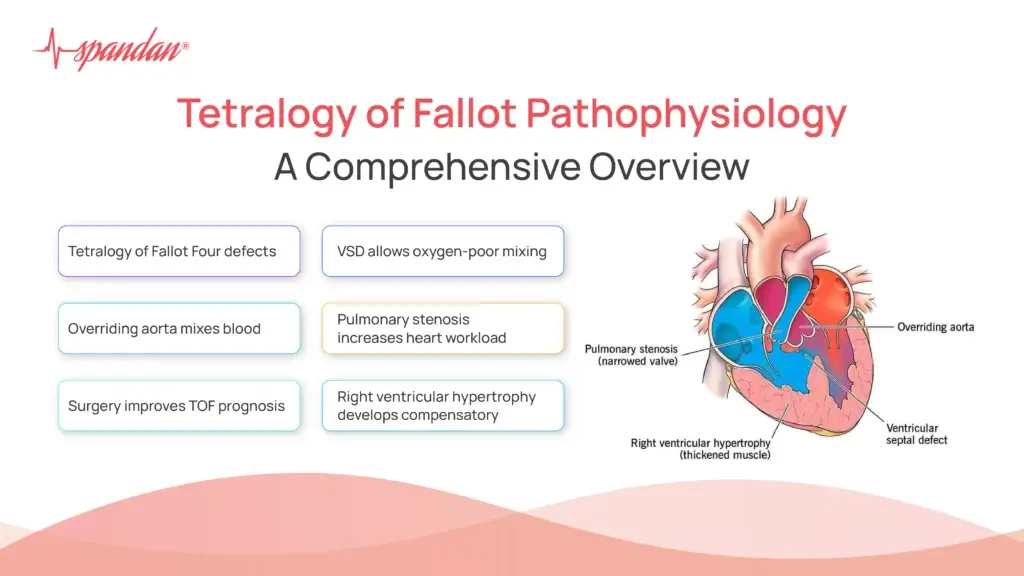 Understanding Tetralogy of Fallot Pathophysiology: A Comprehensive Overview