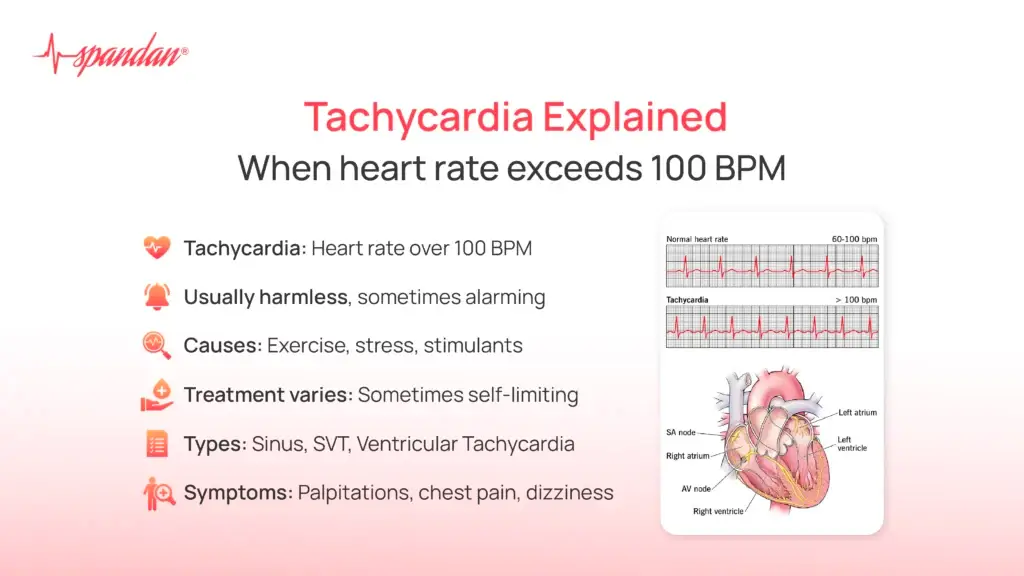 Tachycardia Explained: When heart rate exceeds 100 BPM