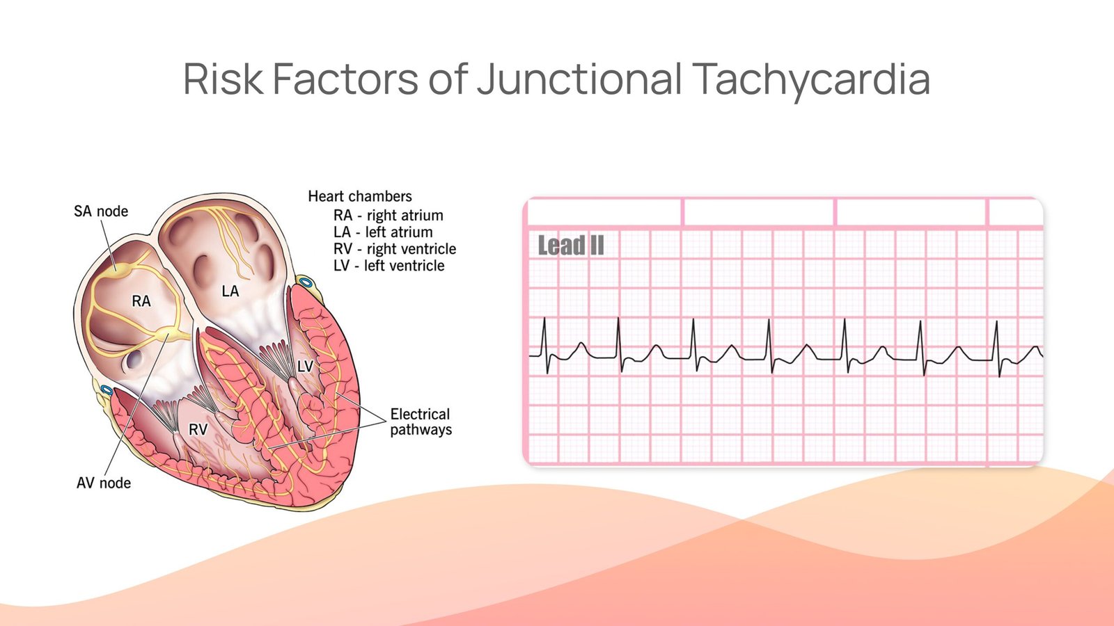 Junctional Tachycardia