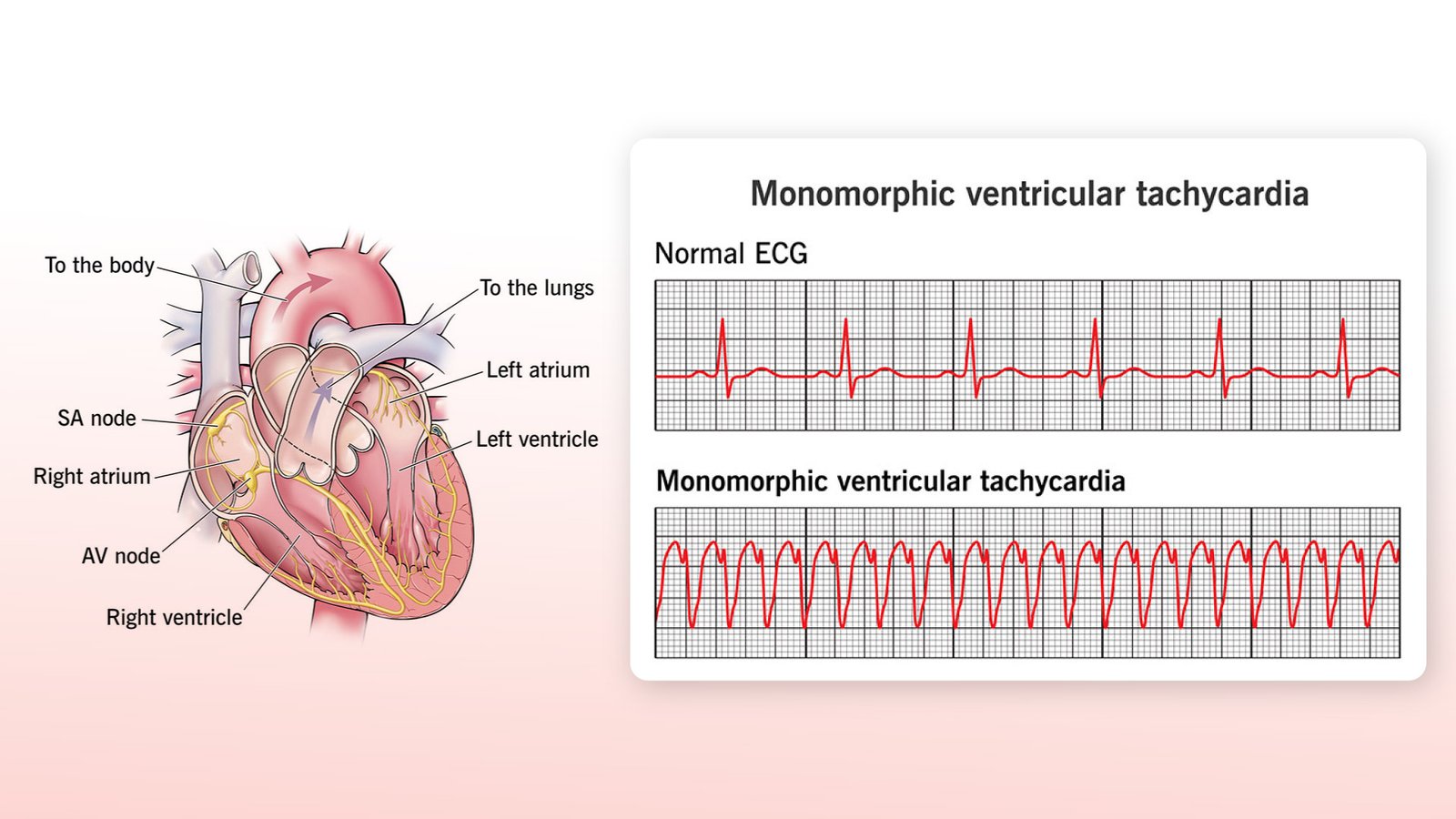 monomorphic ventricular tachycardia