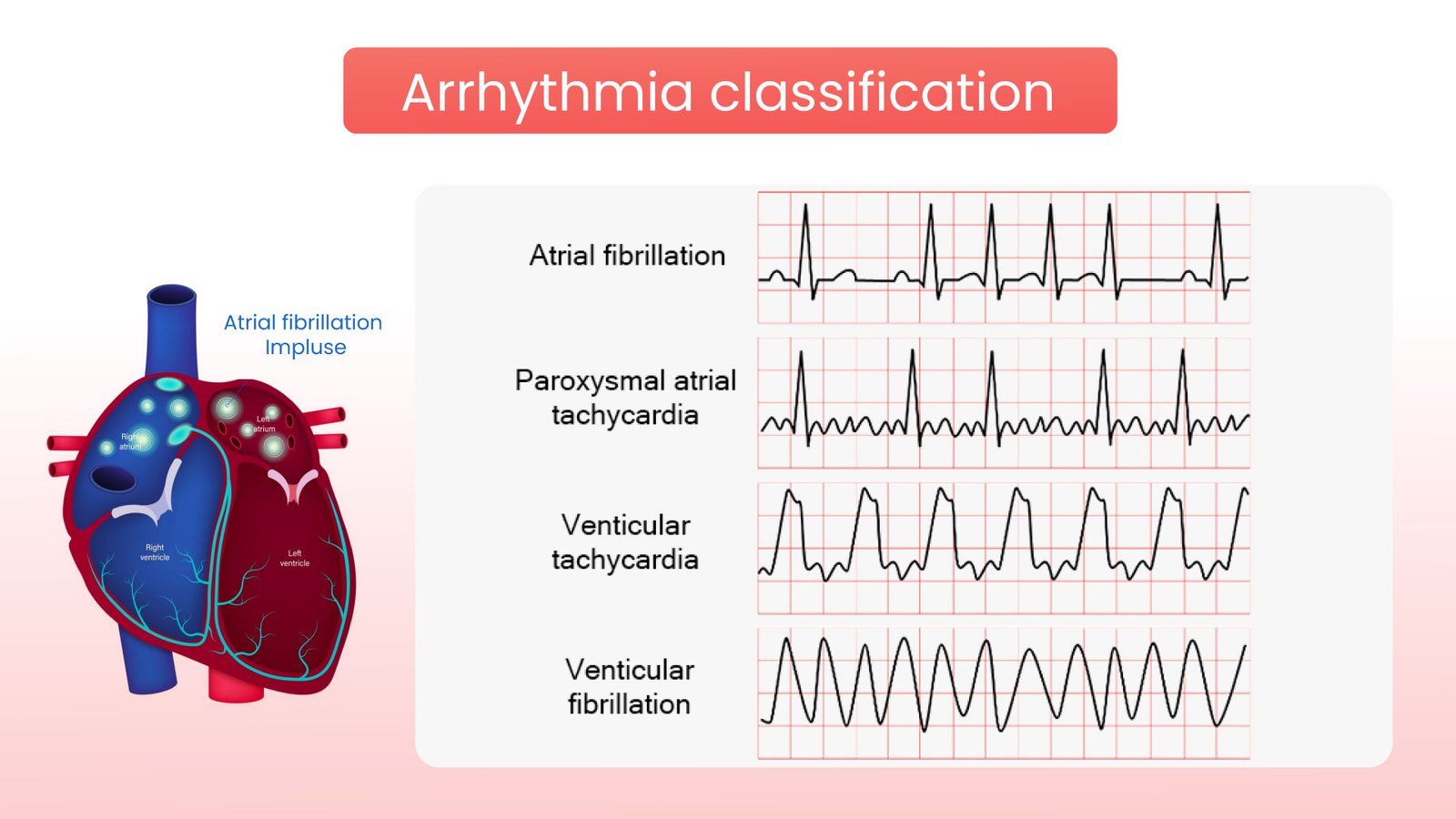 Arrhythmia Classification