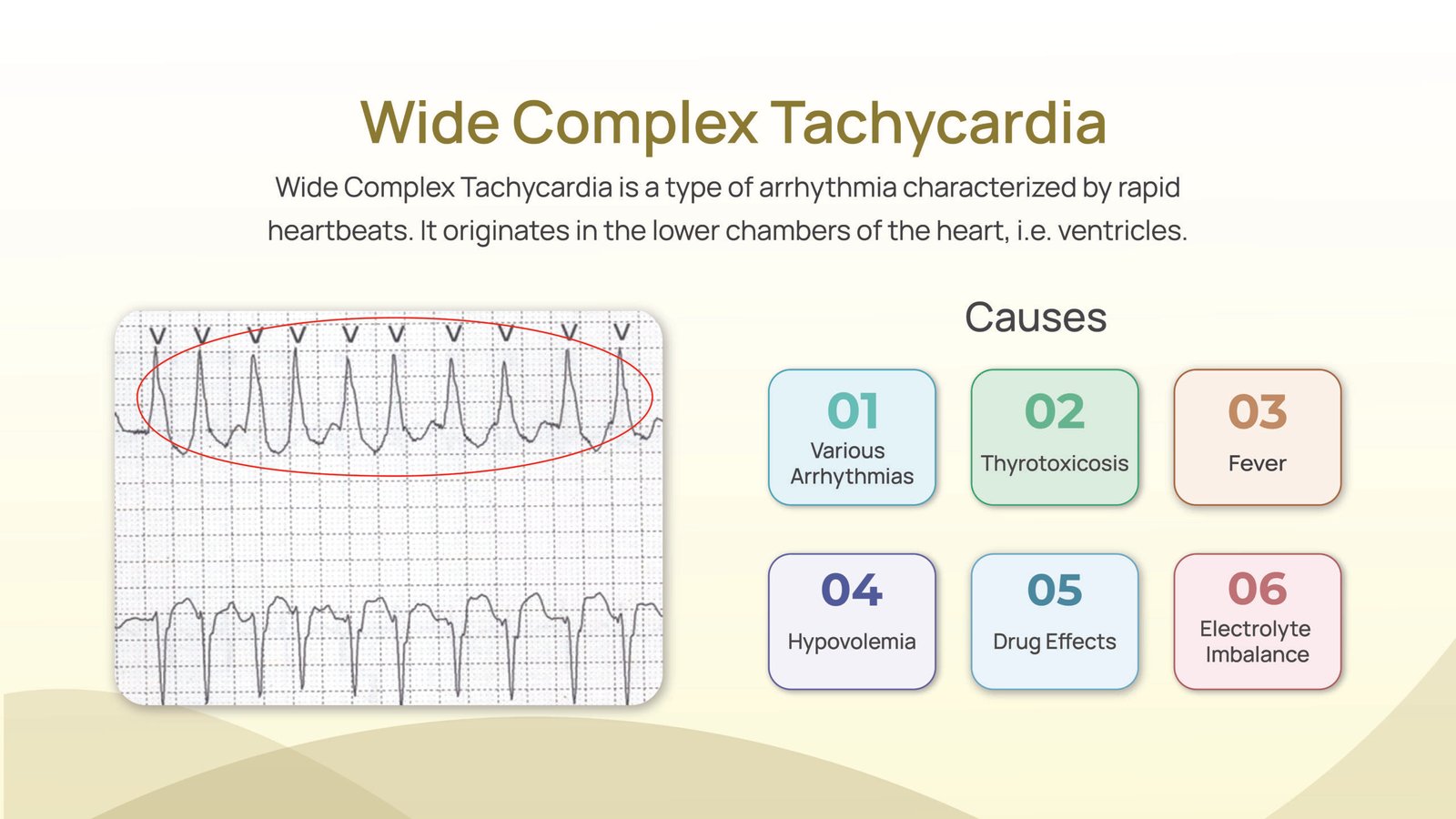 Wide complex Tachycardia