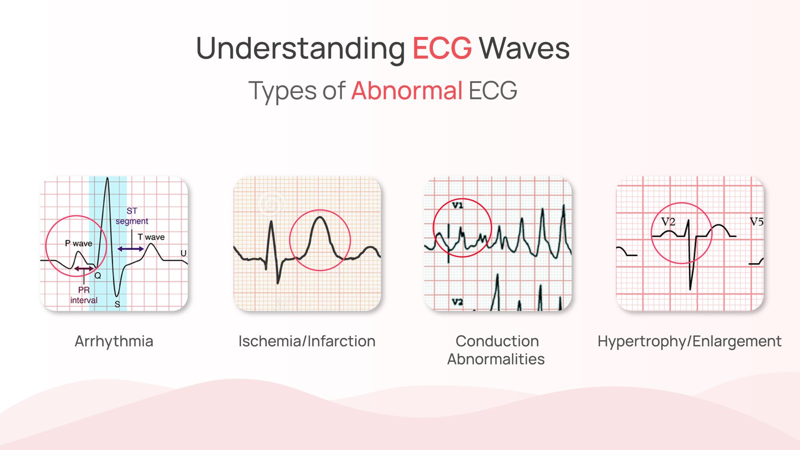 abnormal ecg wave