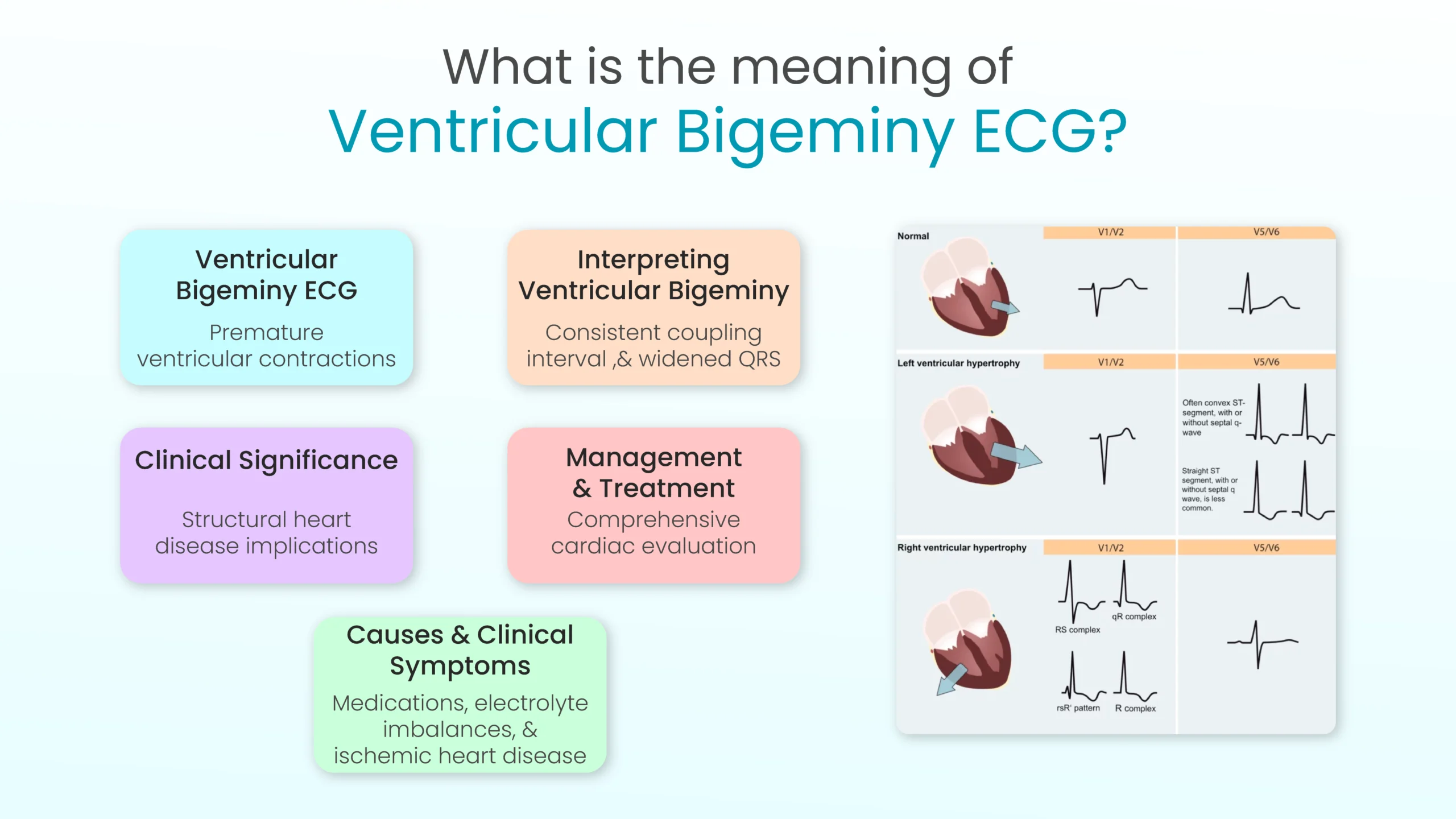 Ventricular Bigeminy ECG