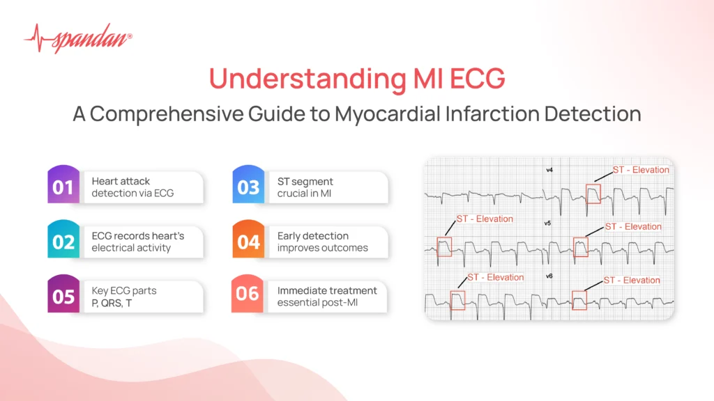 Understanding MI ECG: A Guide to Myocardial Infarction