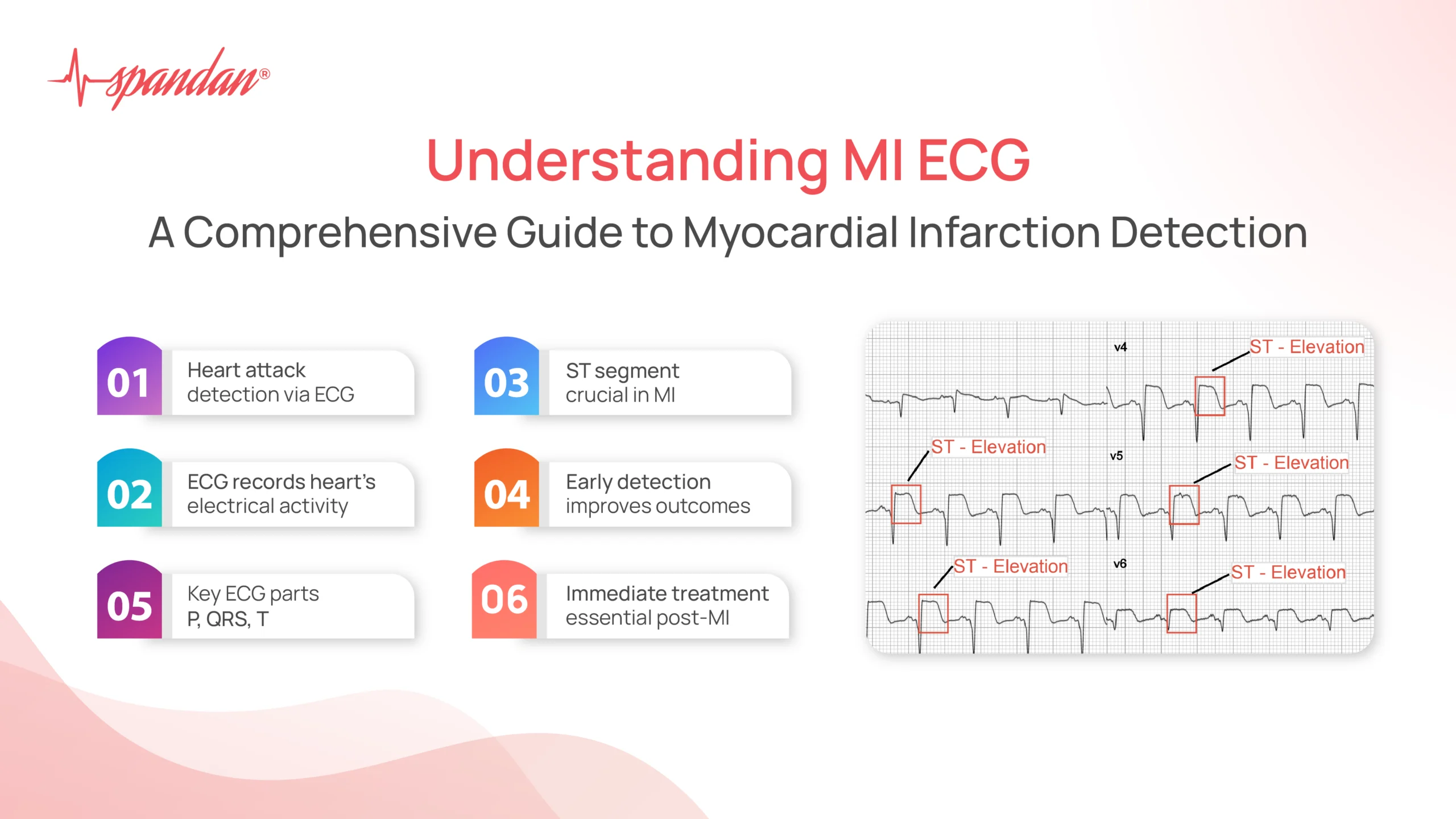 mi ecg