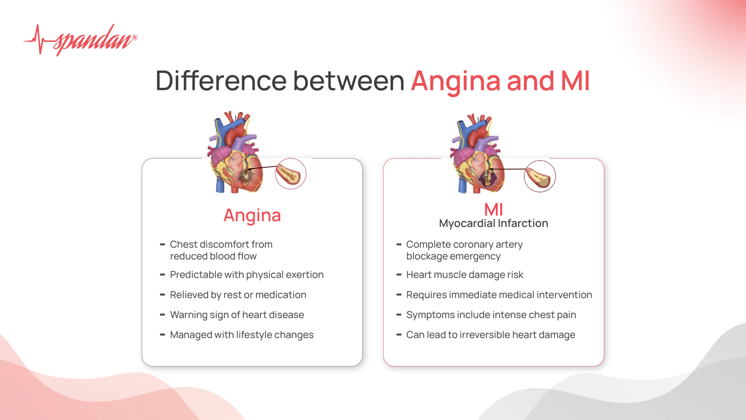 difference between angina and mi