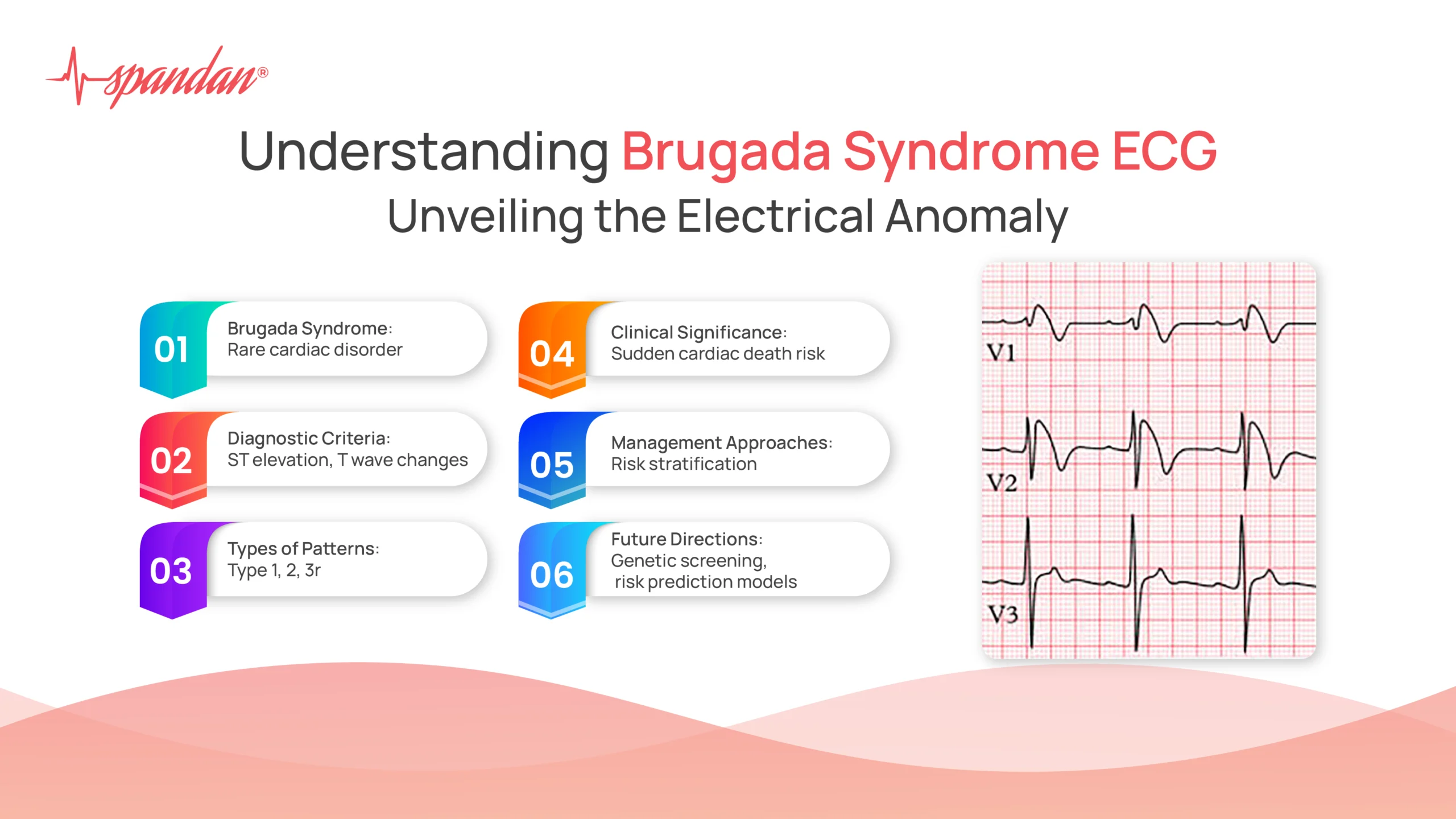 brugada syndrome ecg