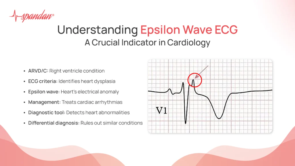 Epsilon Wave ECG: Understanding and Overview