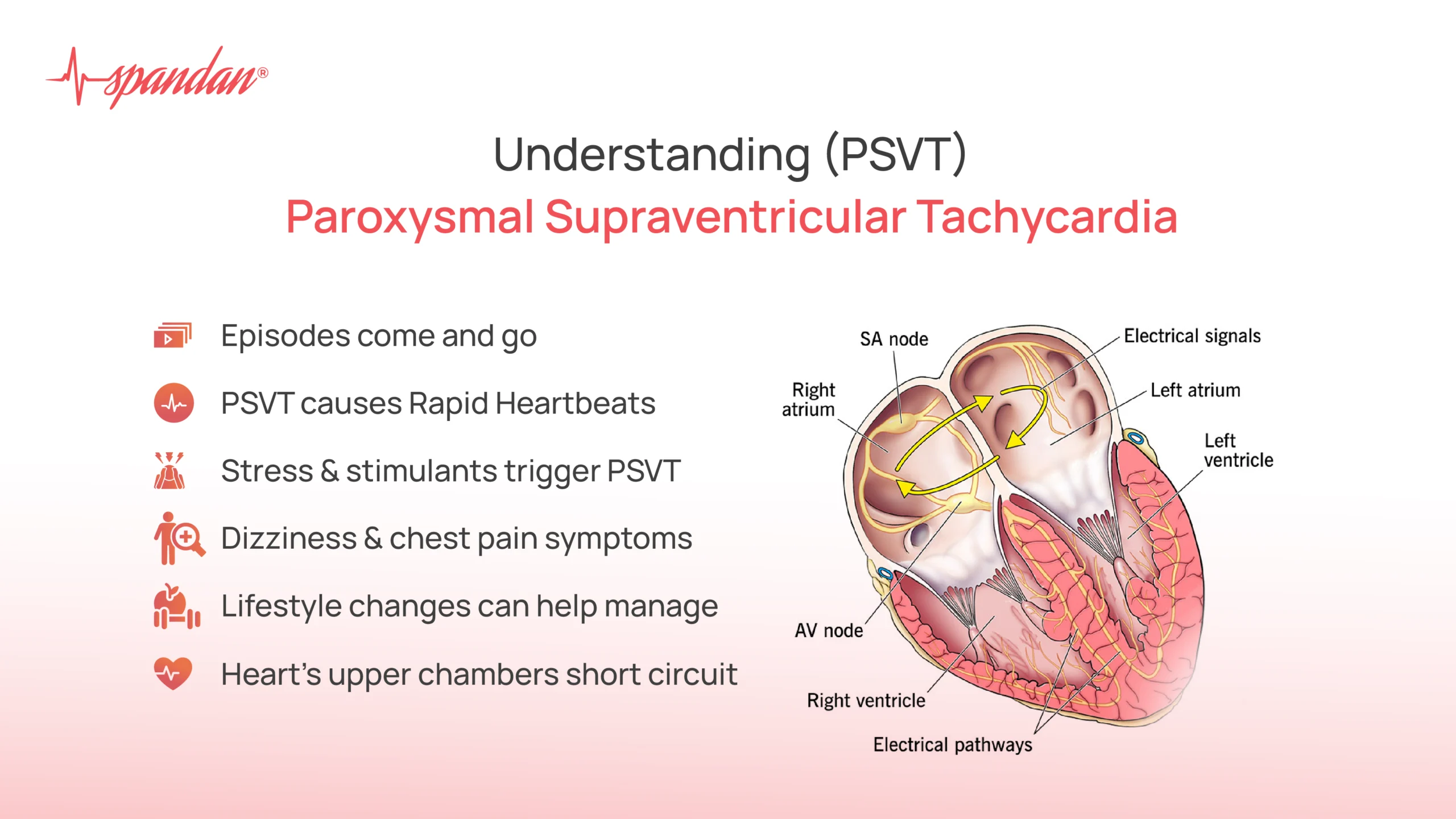 paroxysmal supraventricular tachycardia