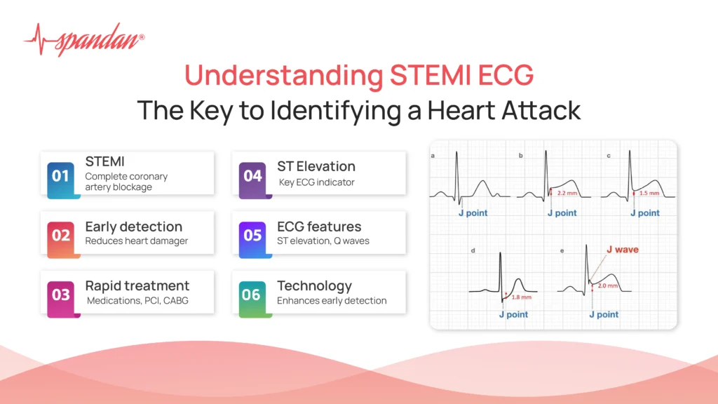 Understanding STEMI ECG: Identifying a Heart Attack