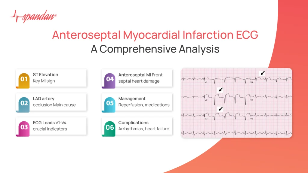 understanding-anteroseptal-myocardial-infarction-ecg