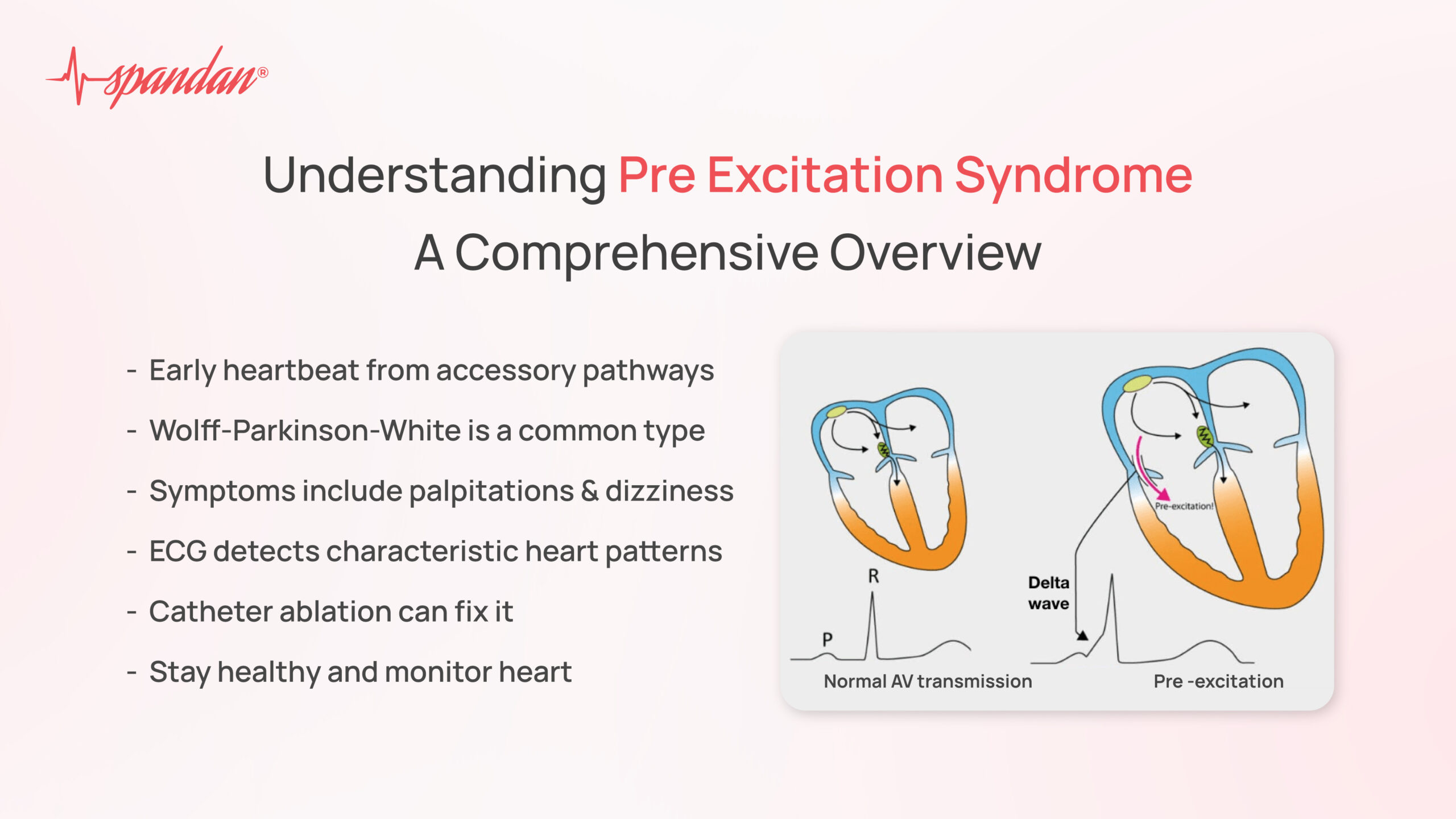 pre excitation syndrome