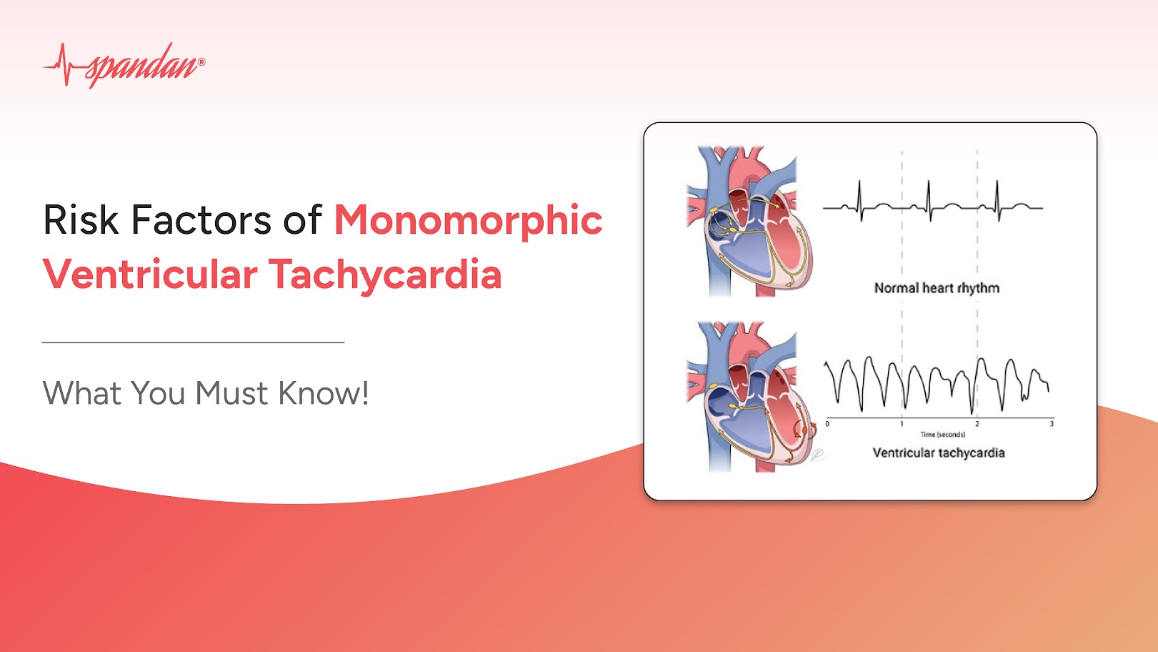 Risk Factors of Monomorphic Ventricular Tachycardia